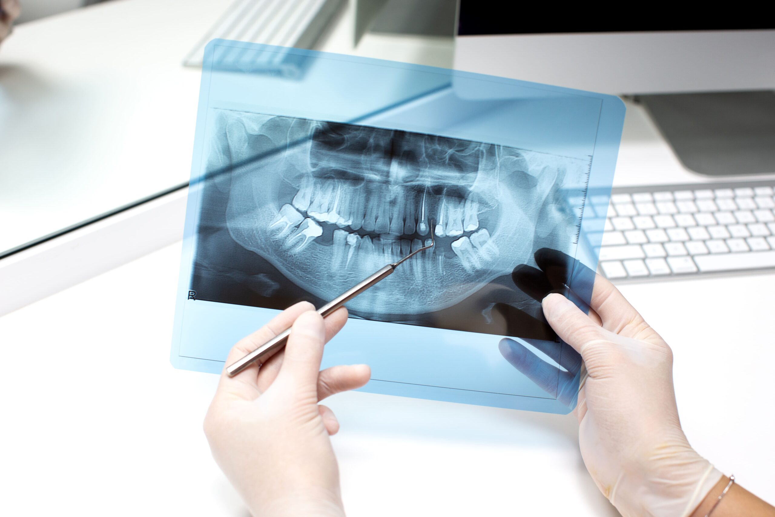 Implantes dentales: ventajas y desventajas